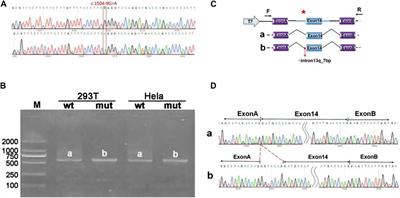 Identification of a novel ANK1 gene variant c.1504-9G>A and its mechanism of intron retention in hereditary spherocytosis